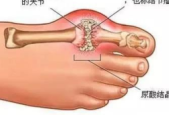痛风祸根并非嘌呤我们对它的误解太深了