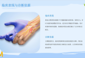 职业性腕管综合征预防方法专家详解