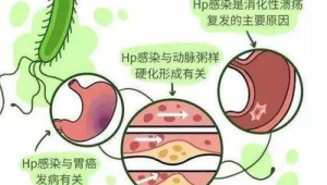 预防胃癌从远离幽门螺杆菌开始  第1张
