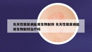国产生物制剂为中重度斑块状银屑病患者提供新选择  第1张