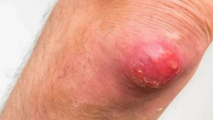 "这种红包又痛又肿硬挤很危险了解这些少跑医院"  第1张