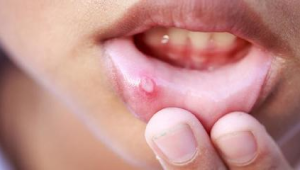 水溶C能治疗口腔溃疡吗  第1张