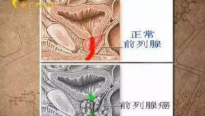 前列腺癌为何常在晚期才被发现  第1张